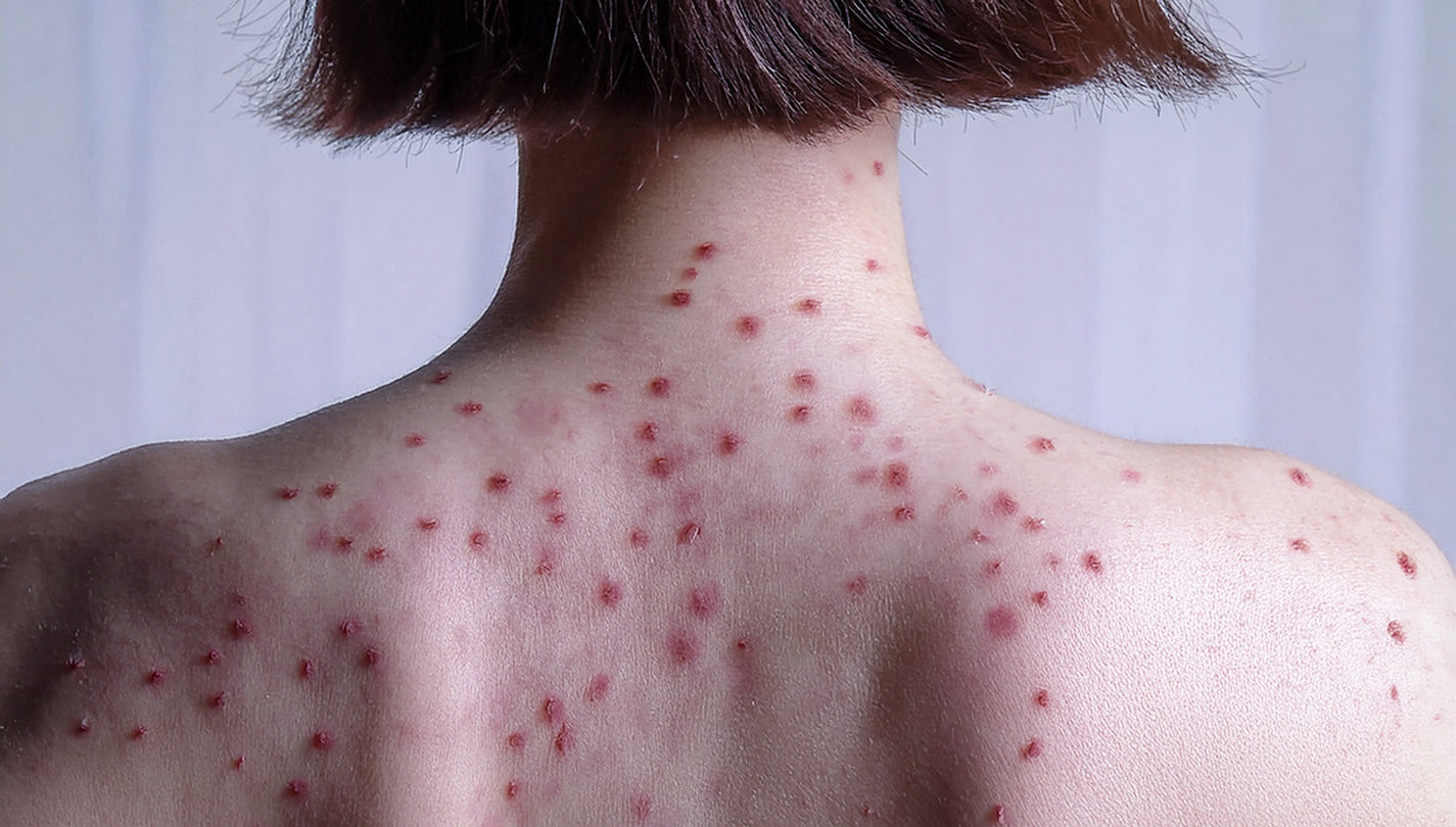 Illustration of blue light destroying P. acnes bacteria and red light soothing dermal inflammation in an acne-prone pore.