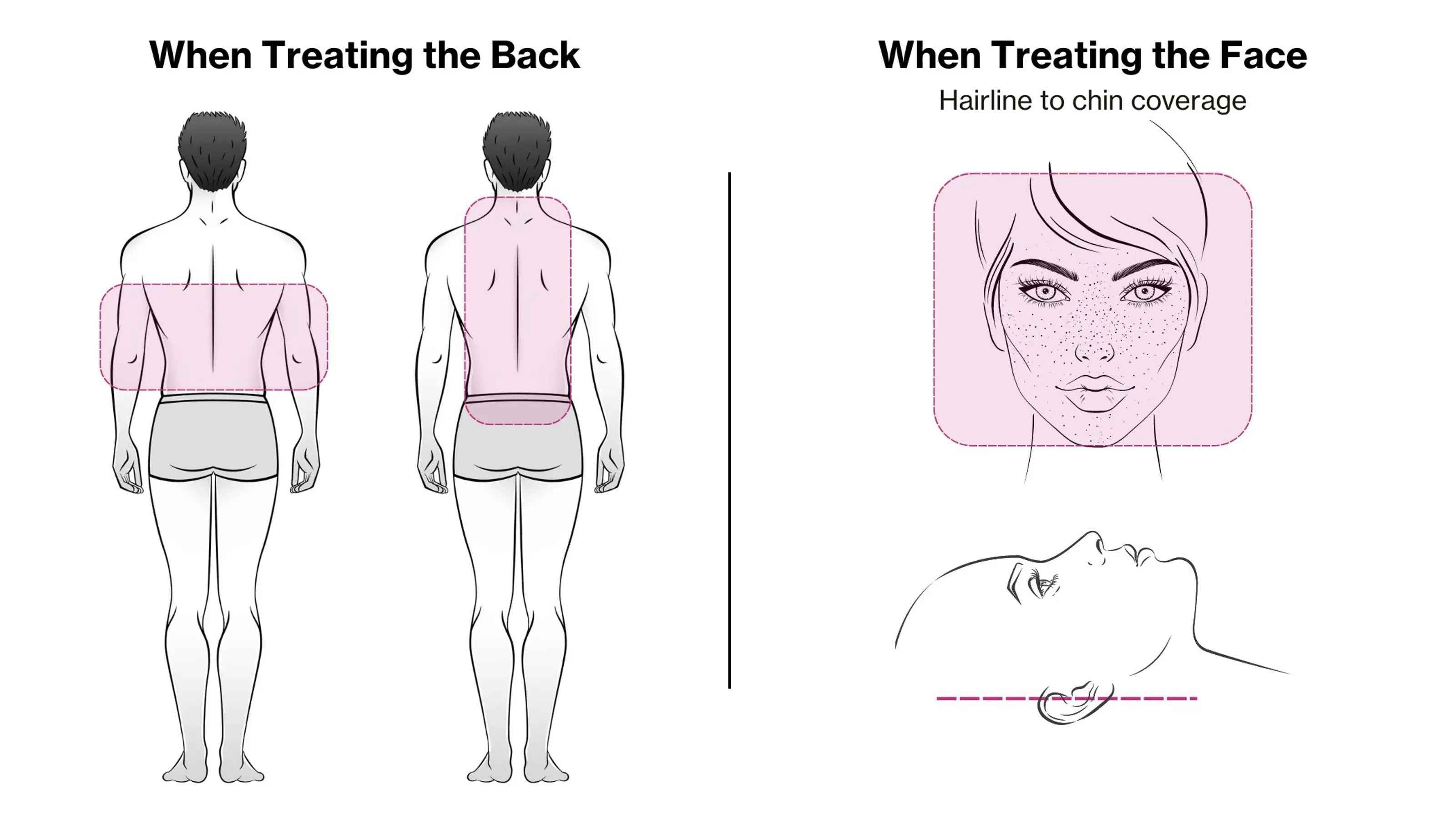 Celluma PRO Plus LED Red Light Therapy positioning on face and back area. 